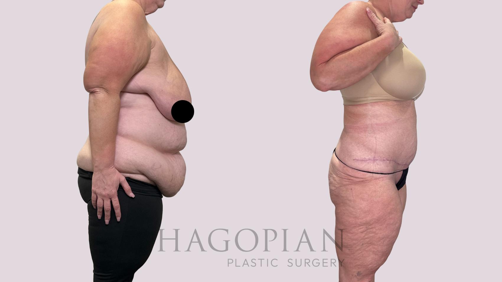 Before & After Drainless Tummy Tuck Case 215 Right Side View in Atlanta, GA