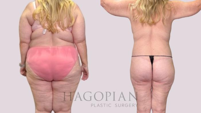 Before & After Drainless Tummy Tuck Case 216 Back View in Atlanta, GA