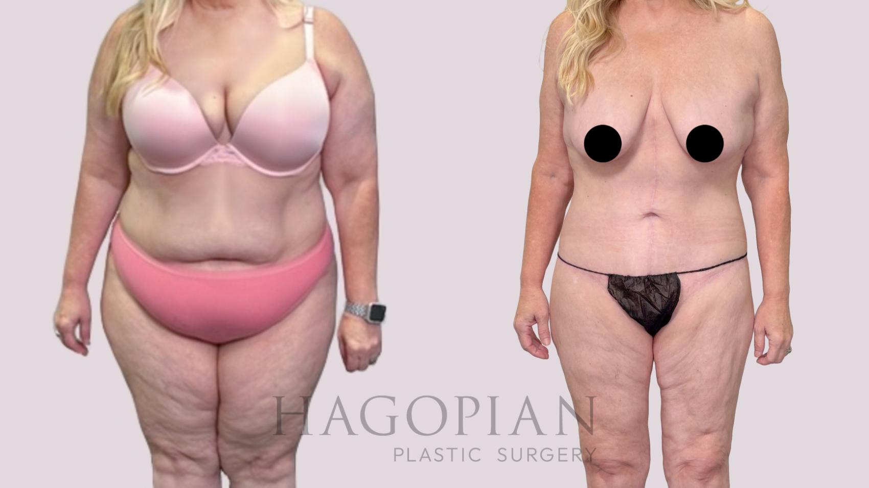 Before & After Drainless Tummy Tuck Case 216 Front View in Atlanta, GA