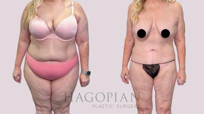 Before & After Drainless Tummy Tuck Case 216 Front View in Atlanta, GA