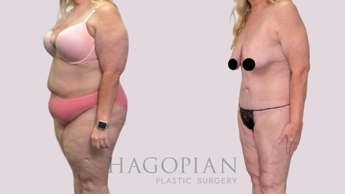 Before & After Drainless Tummy Tuck Case 216 Left Oblique View in Atlanta, GA