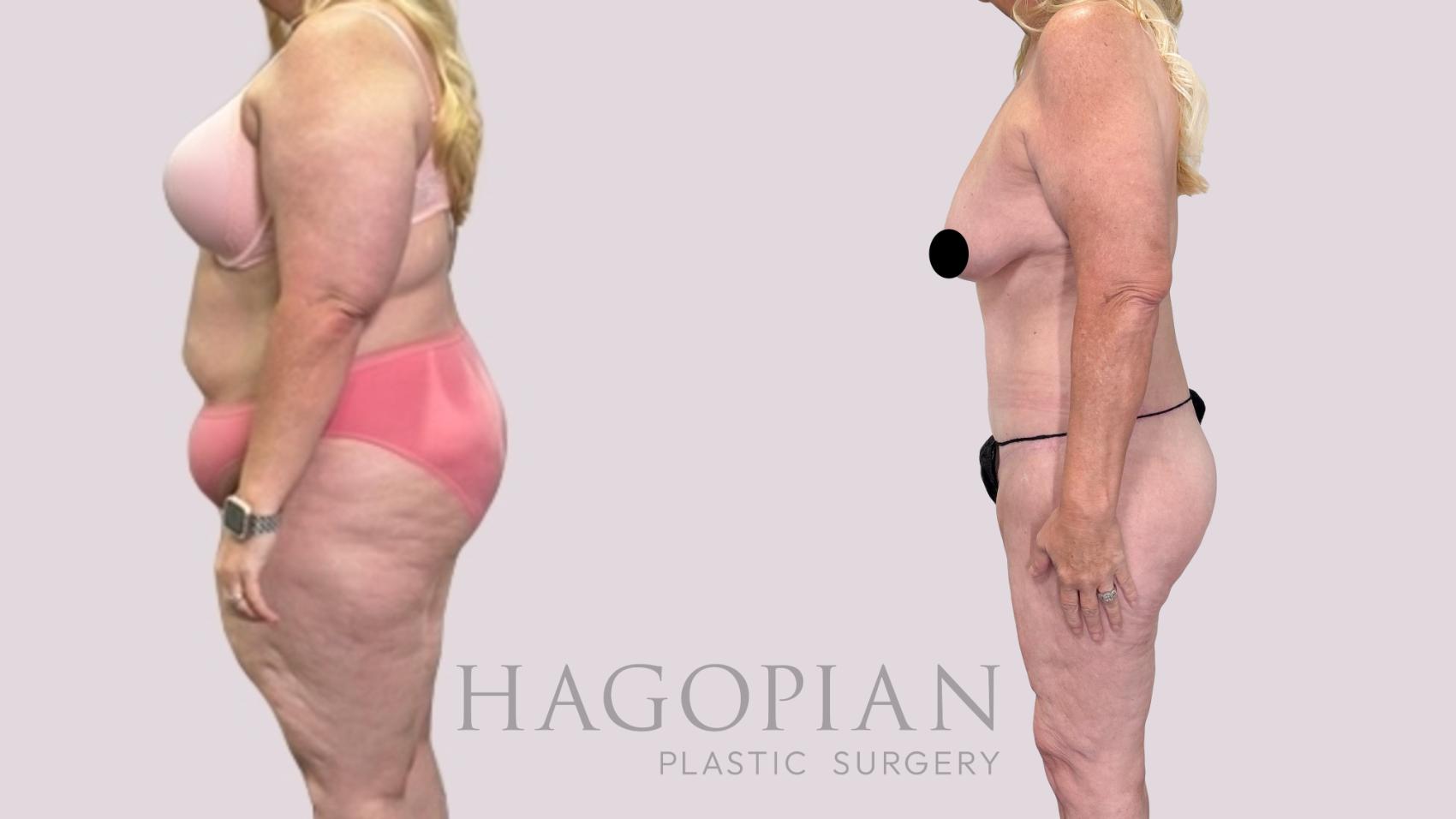 Before & After Drainless Tummy Tuck Case 216 Left Side View in Atlanta, GA
