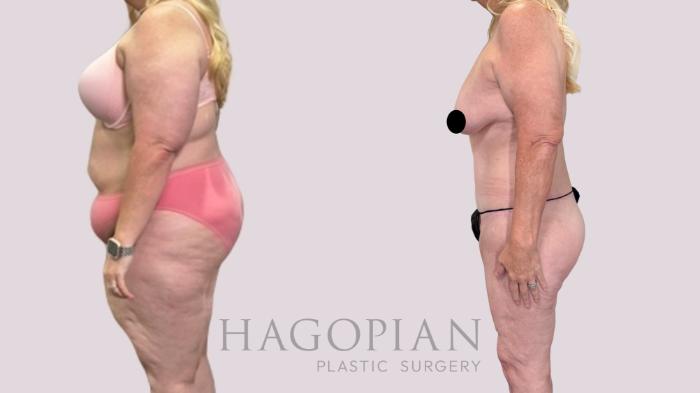 Before & After Drainless Tummy Tuck Case 216 Left Side View in Atlanta, GA