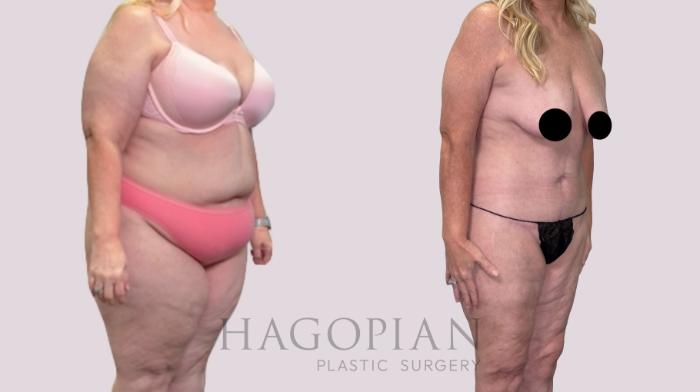 Before & After Drainless Tummy Tuck Case 216 Right Oblique View in Atlanta, GA