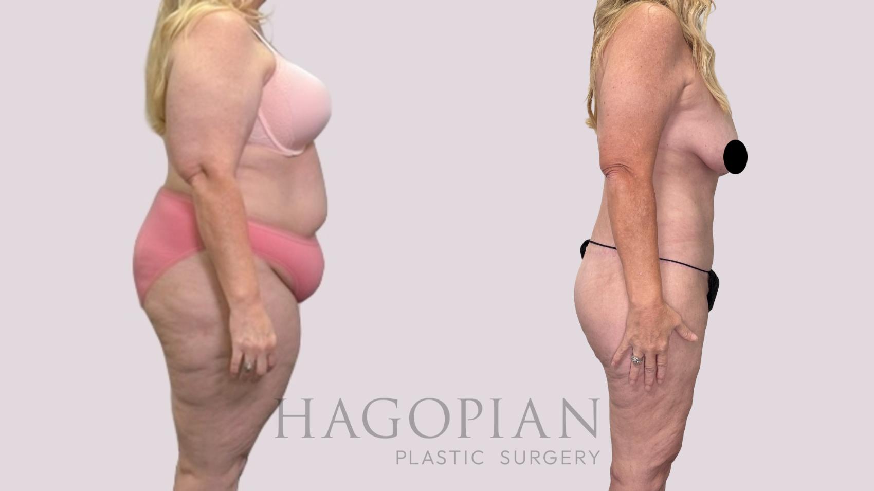 Before & After Drainless Tummy Tuck Case 216 Right Side View in Atlanta, GA