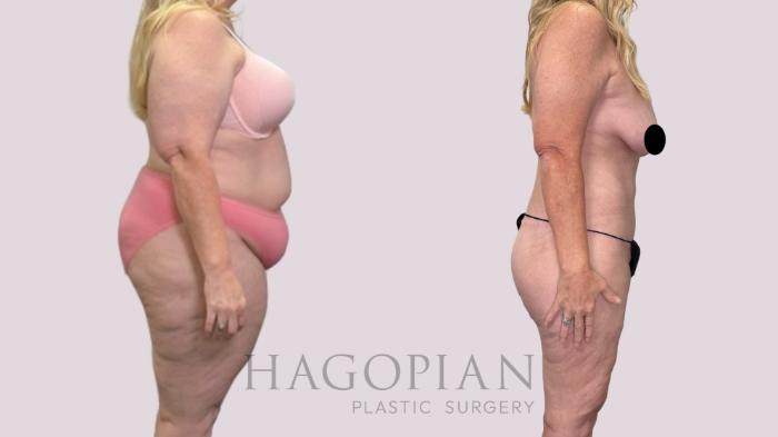 Before & After Drainless Tummy Tuck Case 216 Right Side View in Atlanta, GA