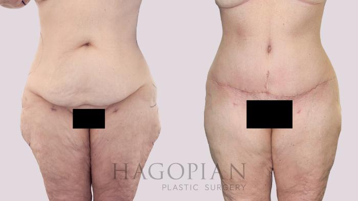 Before & After Drainless Tummy Tuck Case 218 Left Side View in Atlanta, GA