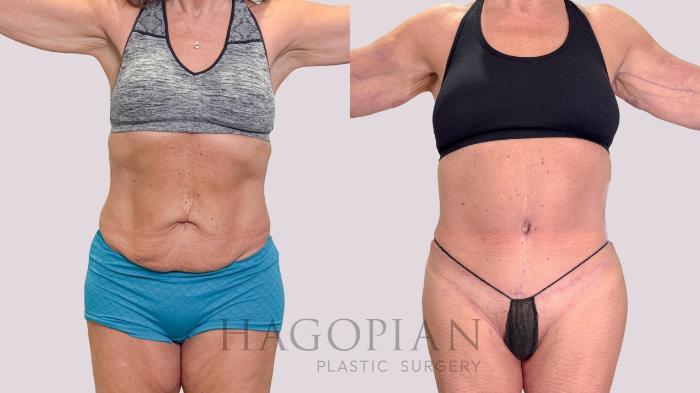 Before & After Drainless Tummy Tuck Case 223 Front View in Atlanta, GA