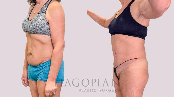 Before & After Drainless Tummy Tuck Case 223 Left Oblique View in Atlanta, GA