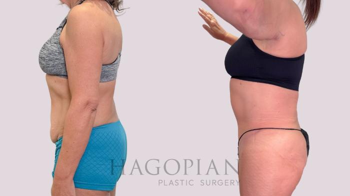 Before & After Drainless Tummy Tuck Case 223 Left Side View in Atlanta, GA