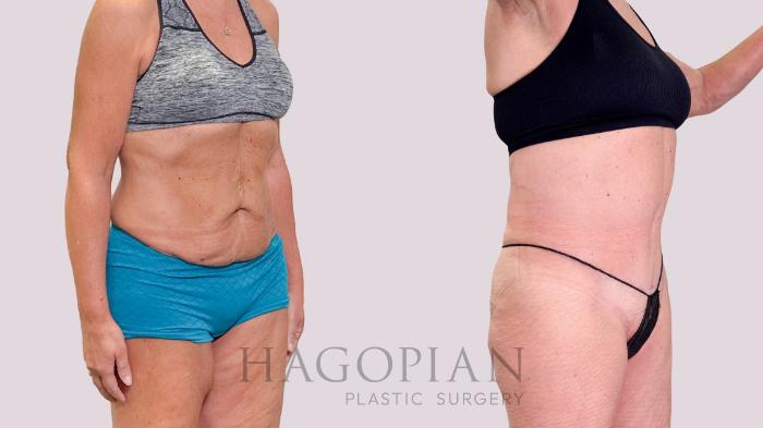 Before & After Drainless Tummy Tuck Case 223 Right Oblique View in Atlanta, GA