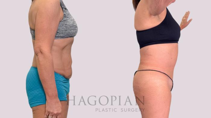 Before & After Drainless Tummy Tuck Case 223 Right Side View in Atlanta, GA