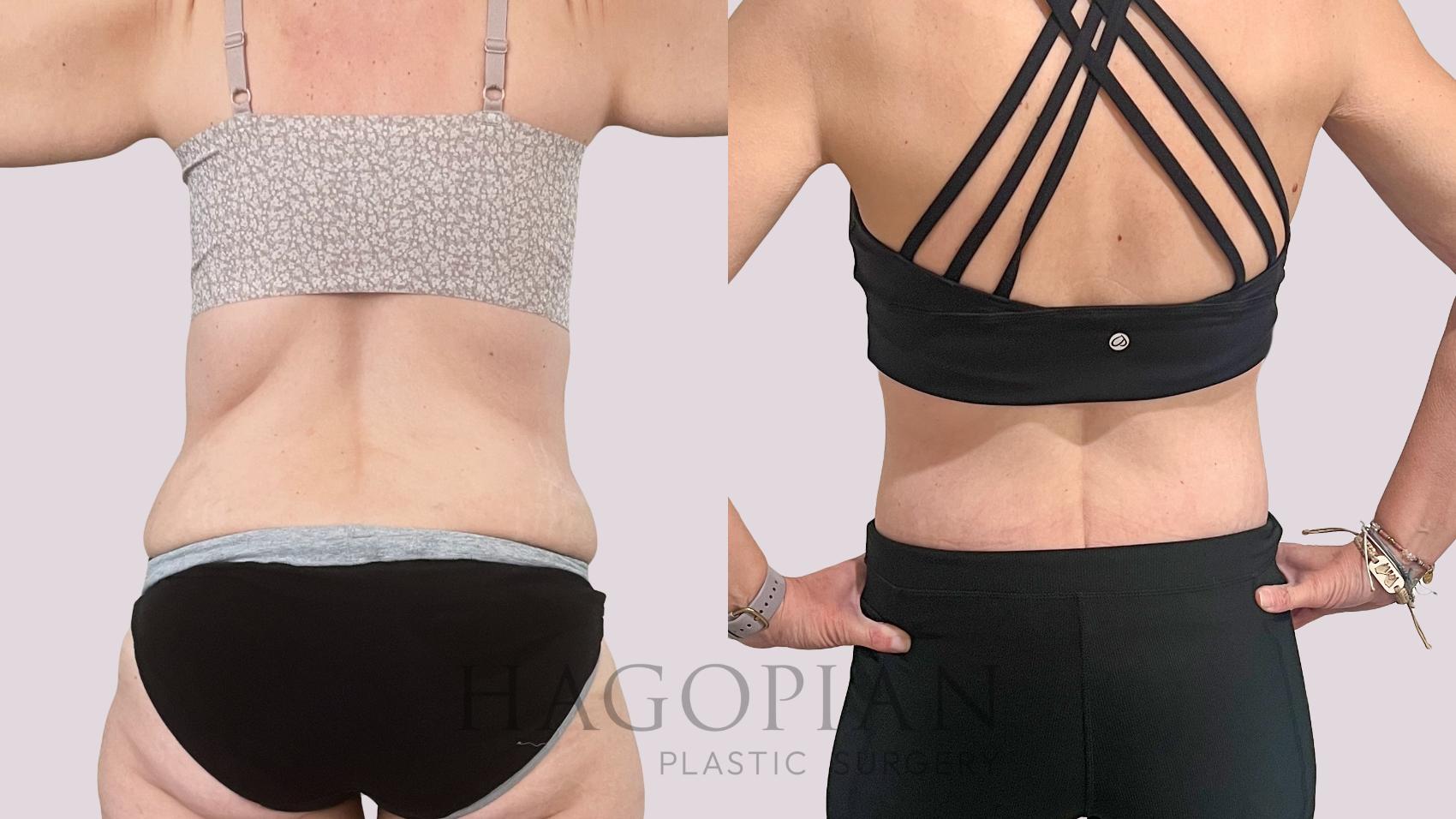 Before & After Drainless Tummy Tuck Case 228 Back View in Atlanta, GA