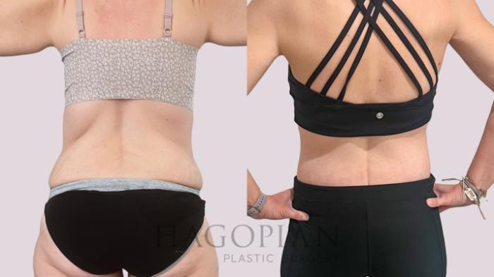 Before & After Drainless Tummy Tuck Case 228 Back View in Atlanta, GA