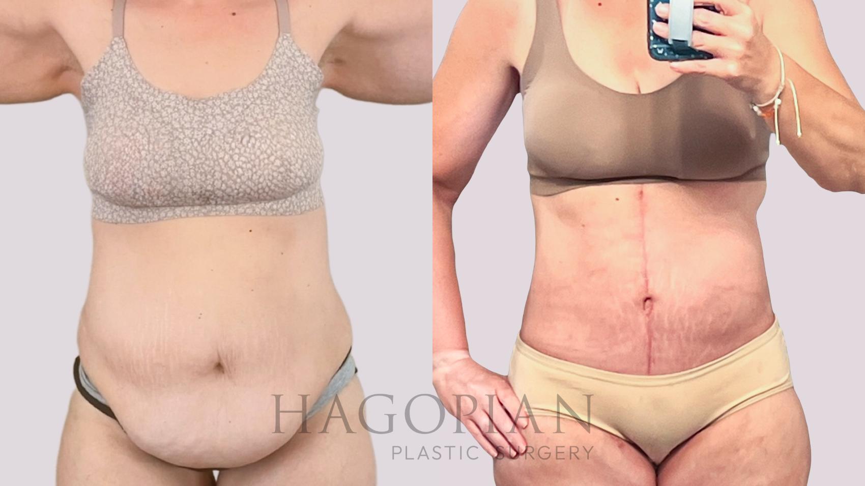 Before & After Drainless Tummy Tuck Case 228 Left Side View in Atlanta, GA