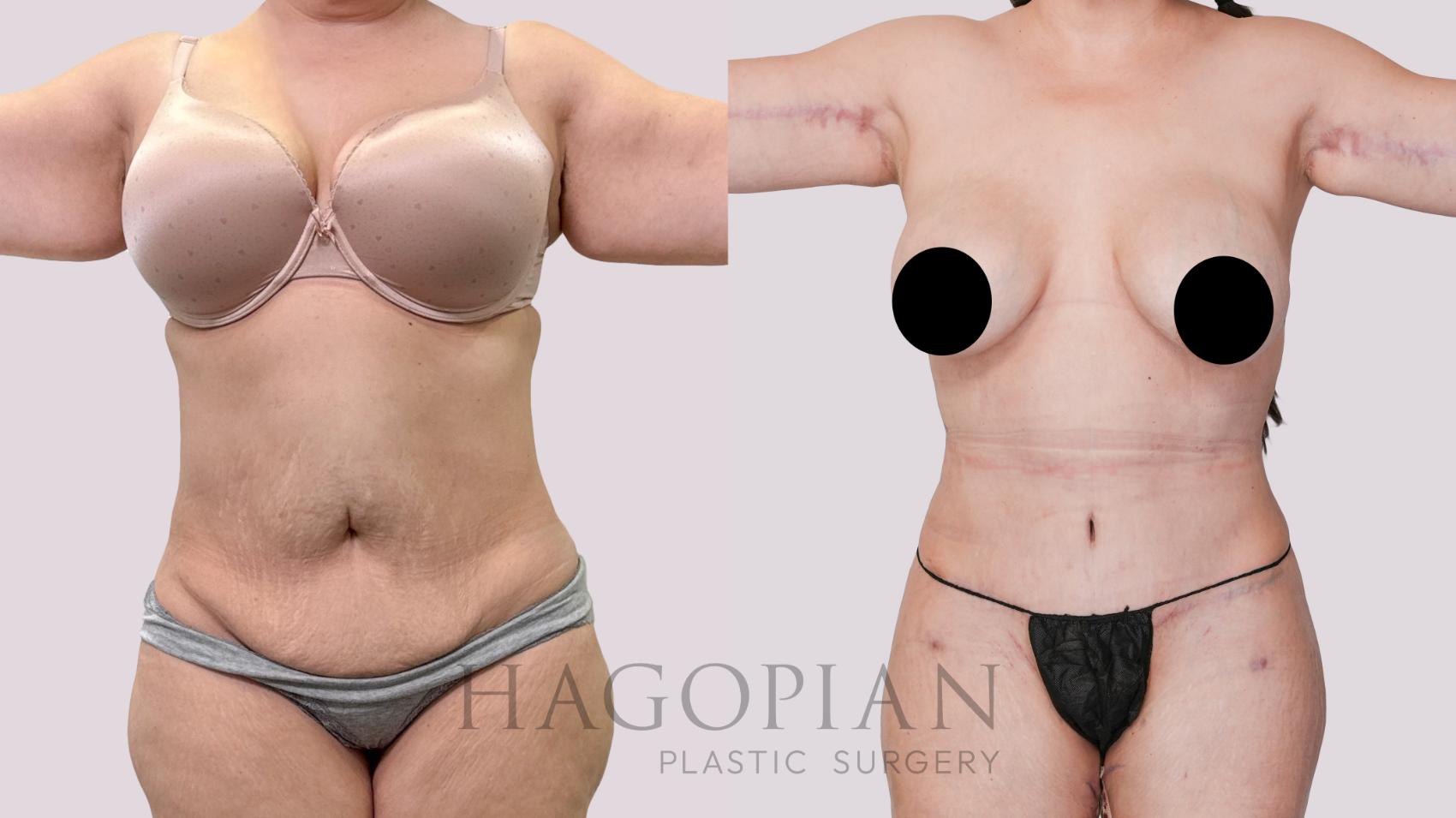 Before & After Drainless Tummy Tuck Case 247 Front View in Atlanta, GA