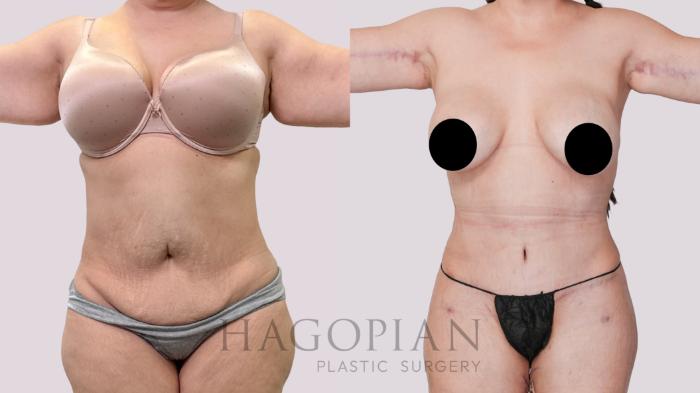 Before & After Drainless Tummy Tuck Case 247 Front View in Atlanta, GA