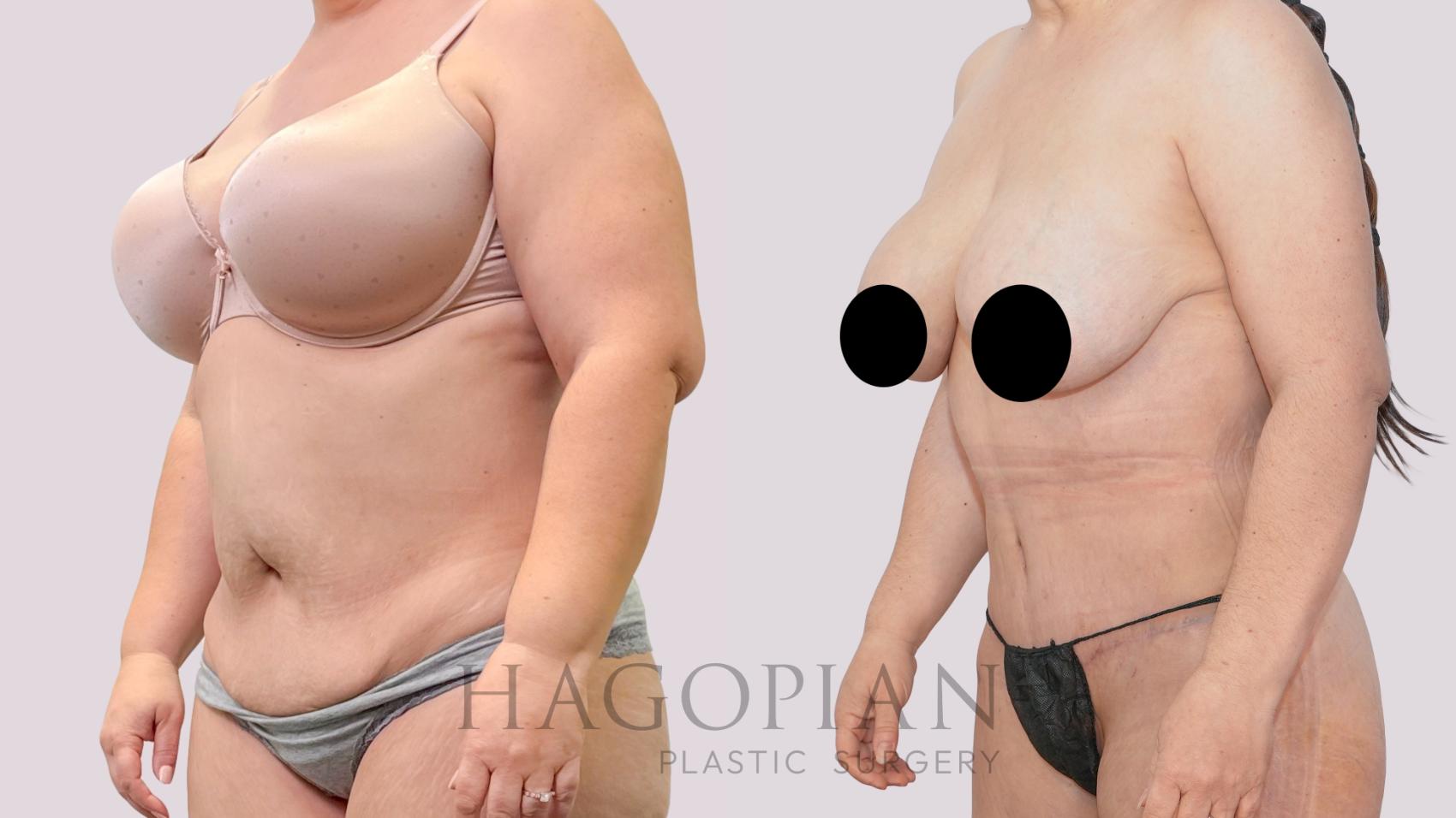 Before & After Drainless Tummy Tuck Case 247 Left Oblique View in Atlanta, GA