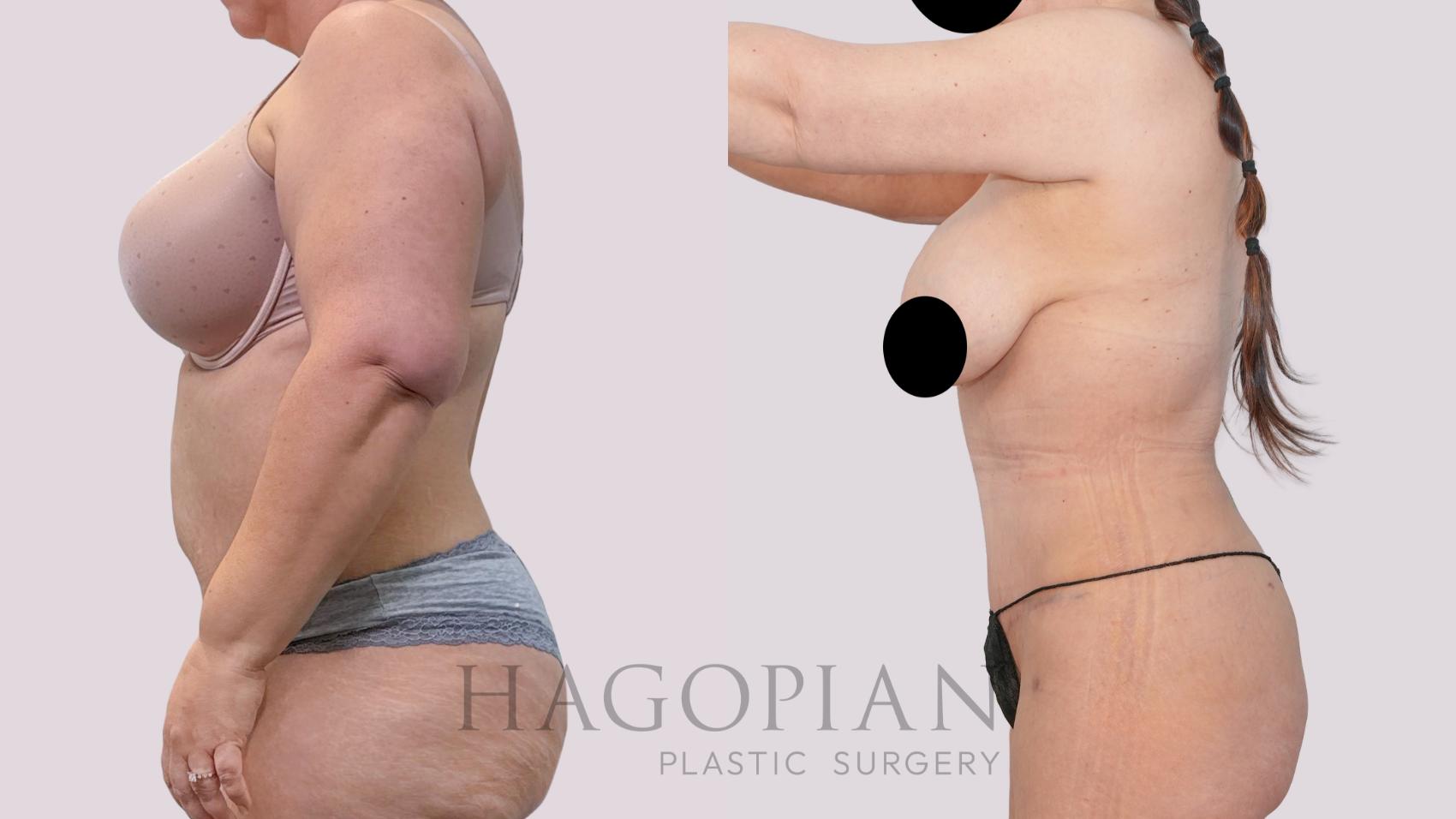 Before & After Drainless Tummy Tuck Case 247 Left Side View in Atlanta, GA