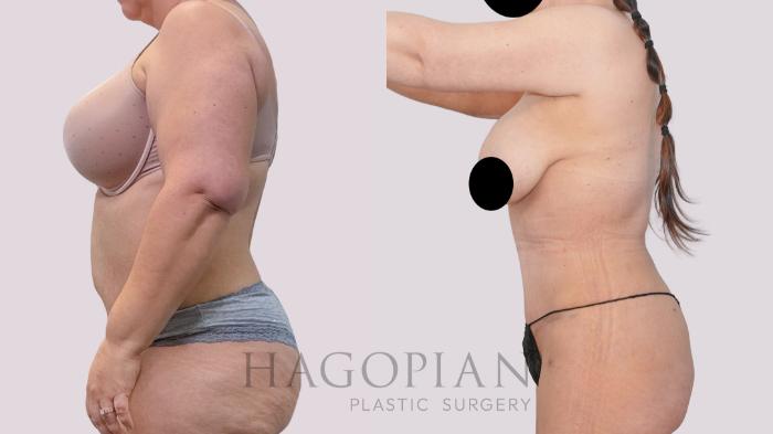 Before & After Drainless Tummy Tuck Case 247 Left Side View in Atlanta, GA