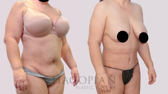 Before & After Drainless Tummy Tuck Case 247 Right Oblique View in Atlanta, GA