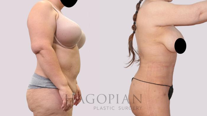 Before & After Drainless Tummy Tuck Case 247 Right Side View in Atlanta, GA