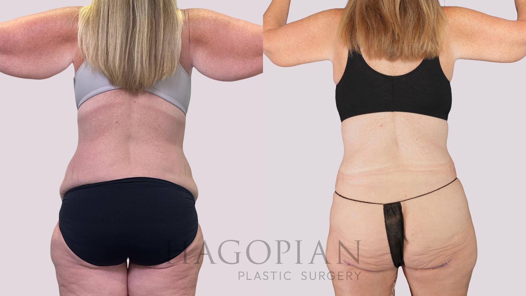 Before & After Drainless Tummy Tuck Case 251 Back View in Atlanta, GA
