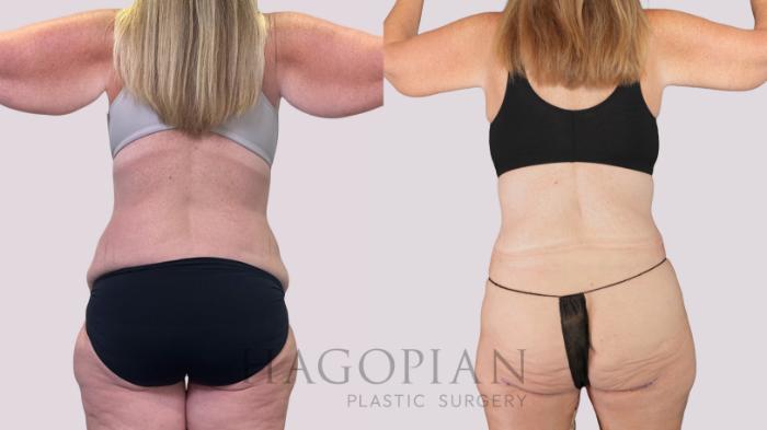 Before & After Drainless Tummy Tuck Case 251 Back View in Atlanta, GA