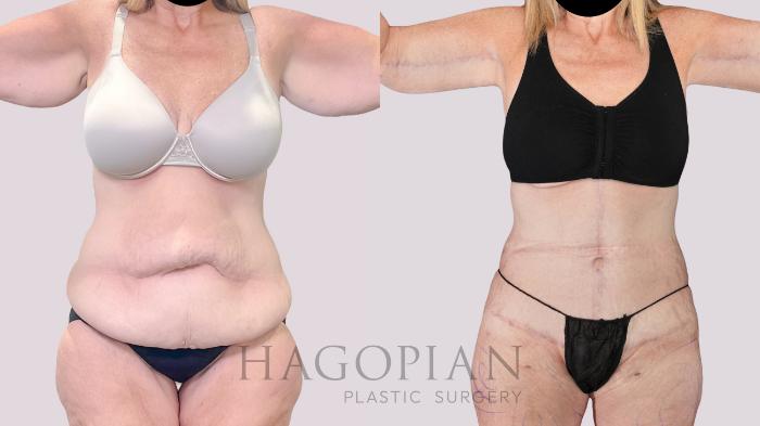 Before & After Drainless Tummy Tuck Case 251 Front View in Atlanta, GA