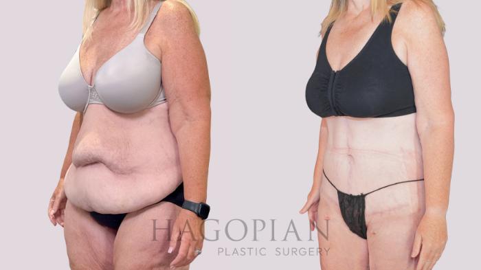 Before & After Drainless Tummy Tuck Case 251 Left Oblique View in Atlanta, GA