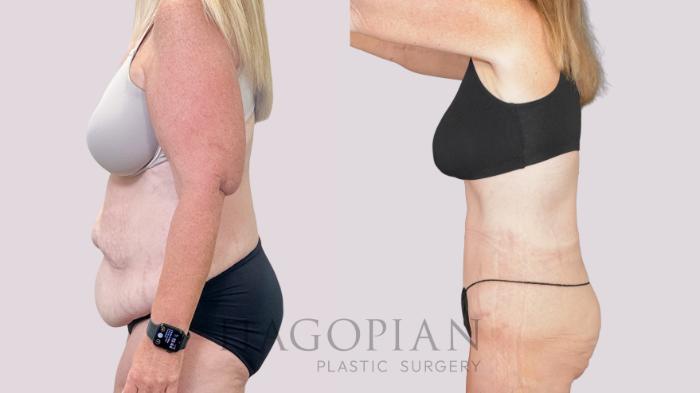 Before & After Drainless Tummy Tuck Case 251 Left Side View in Atlanta, GA