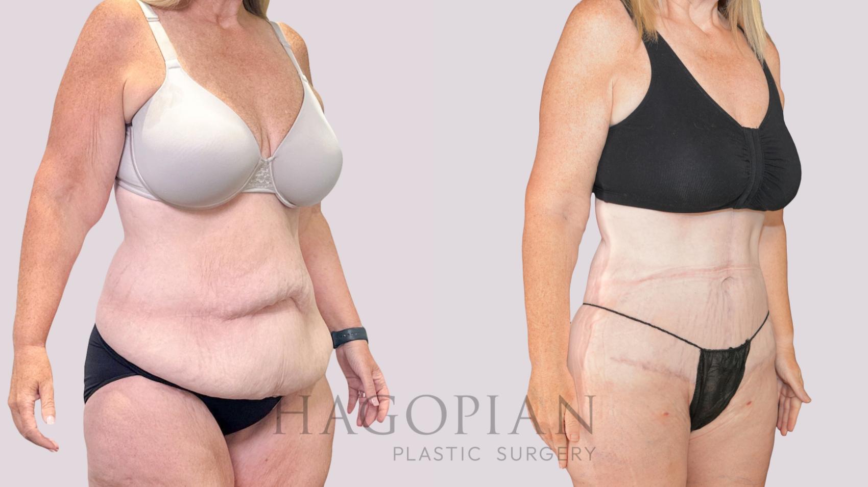 Before & After Drainless Tummy Tuck Case 251 Right Oblique View in Atlanta, GA