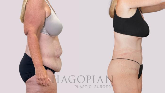Before & After Drainless Tummy Tuck Case 251 Right Side View in Atlanta, GA