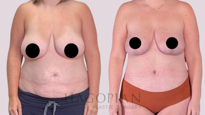 Before & After Drainless Tummy Tuck Case 255 Front View in Atlanta, GA