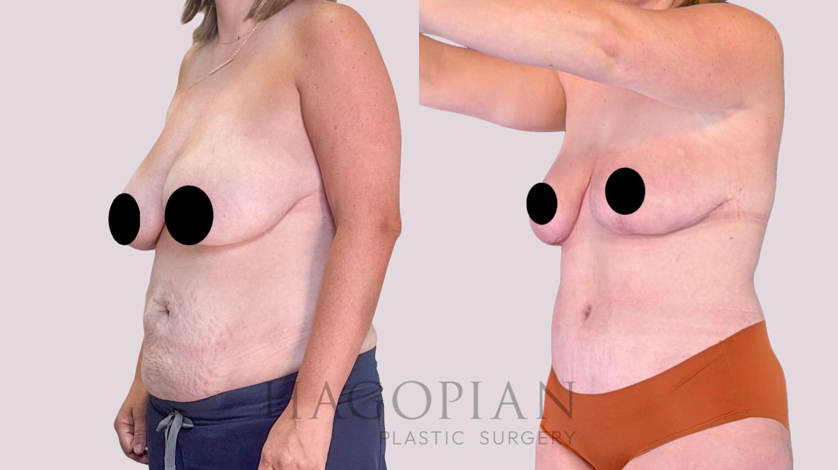 Before & After Drainless Tummy Tuck Case 255 Left Oblique View in Atlanta, GA