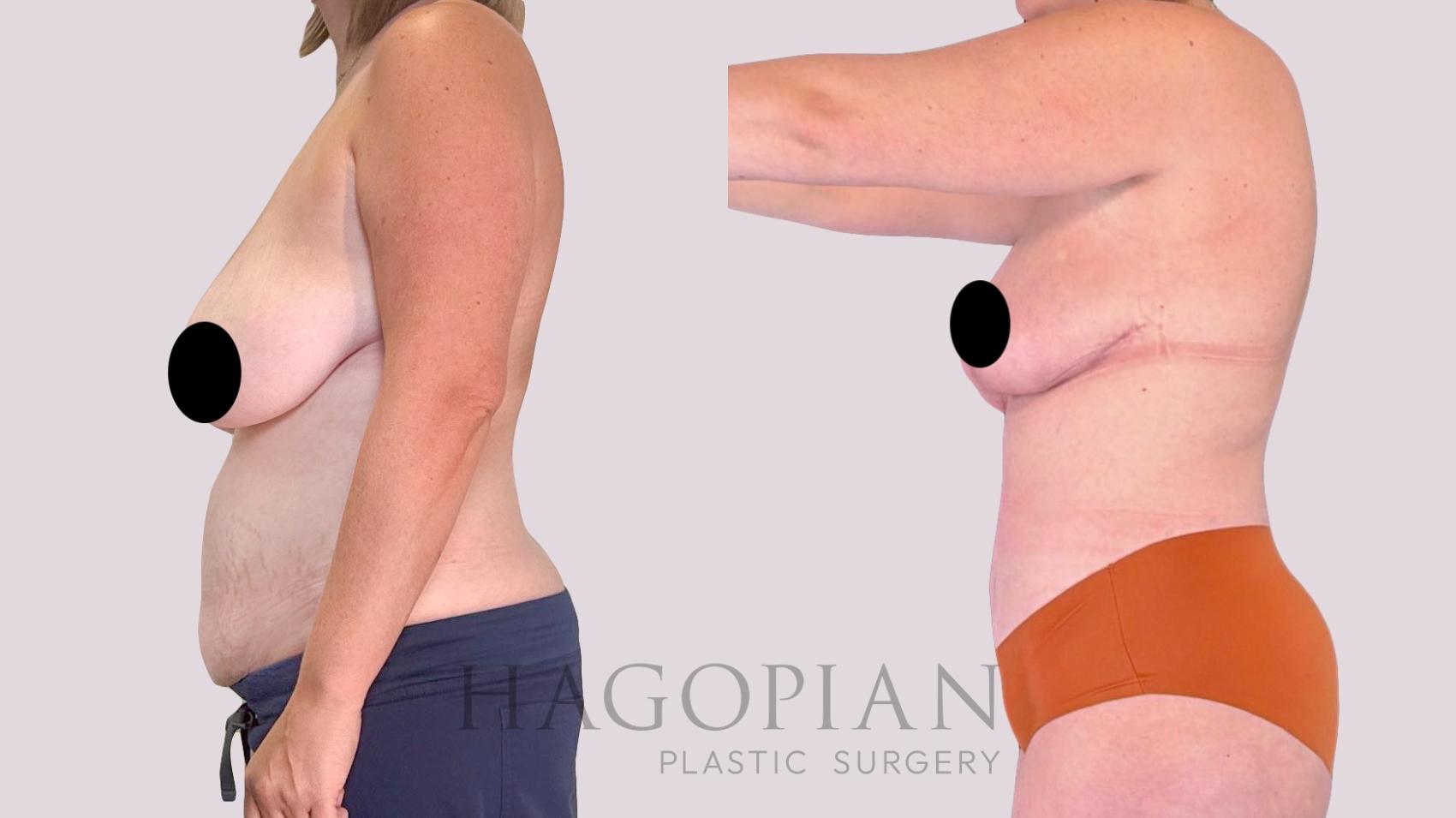Before & After Drainless Tummy Tuck Case 255 Left Side View in Atlanta, GA