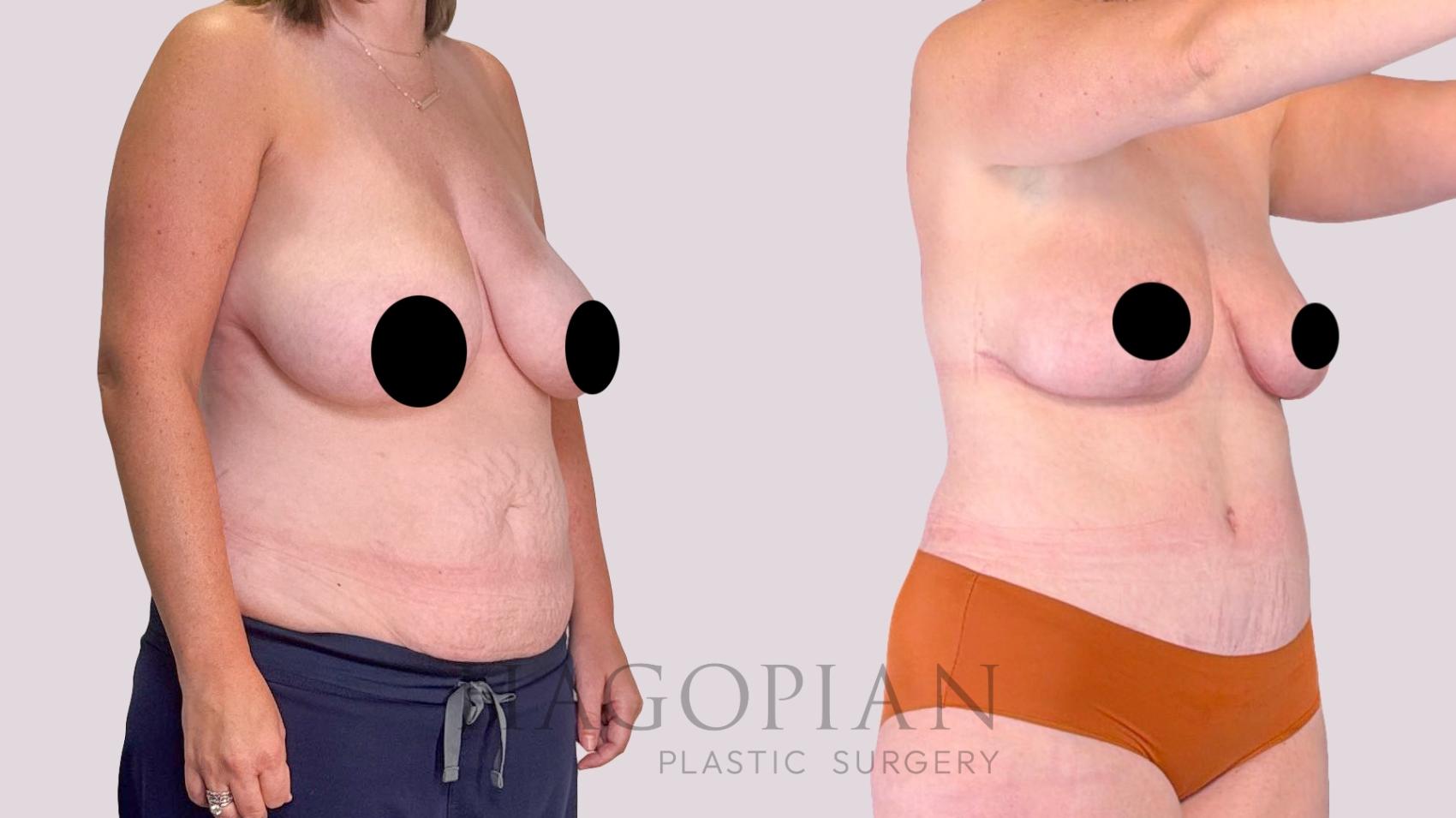 Before & After Drainless Tummy Tuck Case 255 Right Oblique View in Atlanta, GA