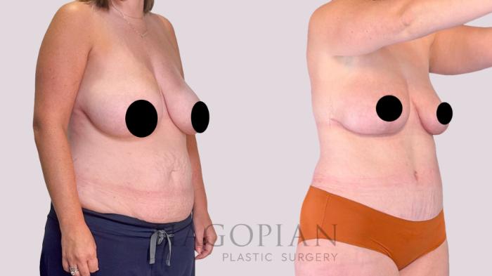 Before & After Drainless Tummy Tuck Case 255 Right Oblique View in Atlanta, GA