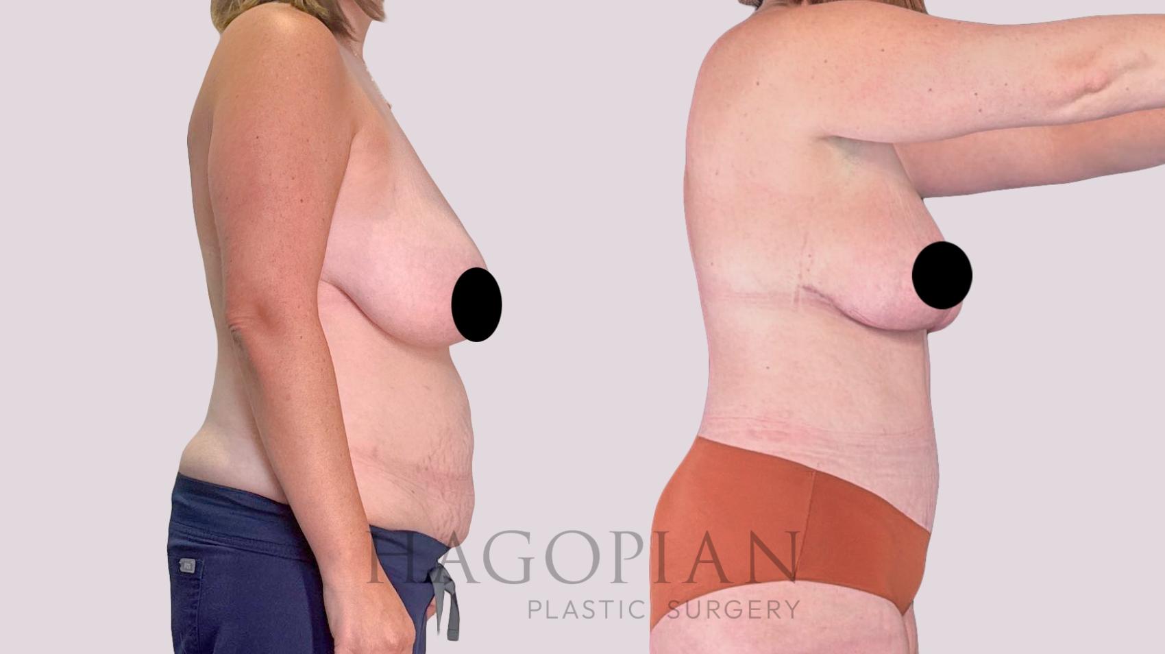 Before & After Drainless Tummy Tuck Case 255 Right Side View in Atlanta, GA
