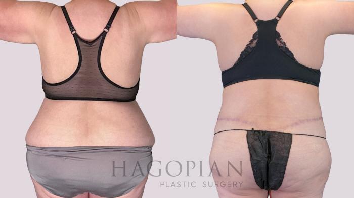 Before & After Drainless Tummy Tuck Case 271 Back View in Atlanta, GA