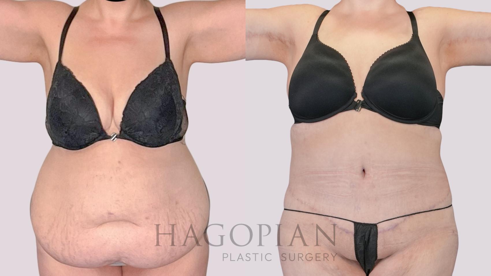 Before & After Drainless Tummy Tuck Case 271 Front View in Atlanta, GA