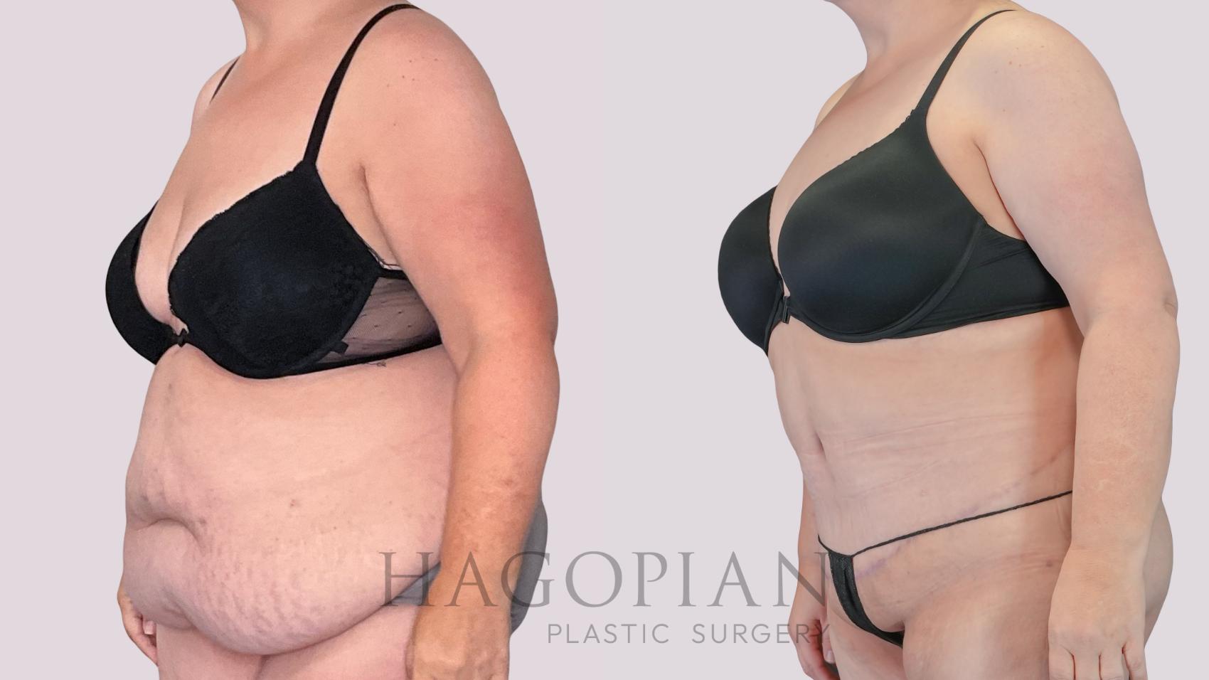 Before & After Drainless Tummy Tuck Case 271 Left Oblique View in Atlanta, GA