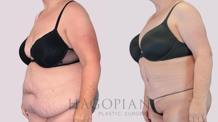 Before & After Drainless Tummy Tuck Case 271 Left Oblique View in Atlanta, GA