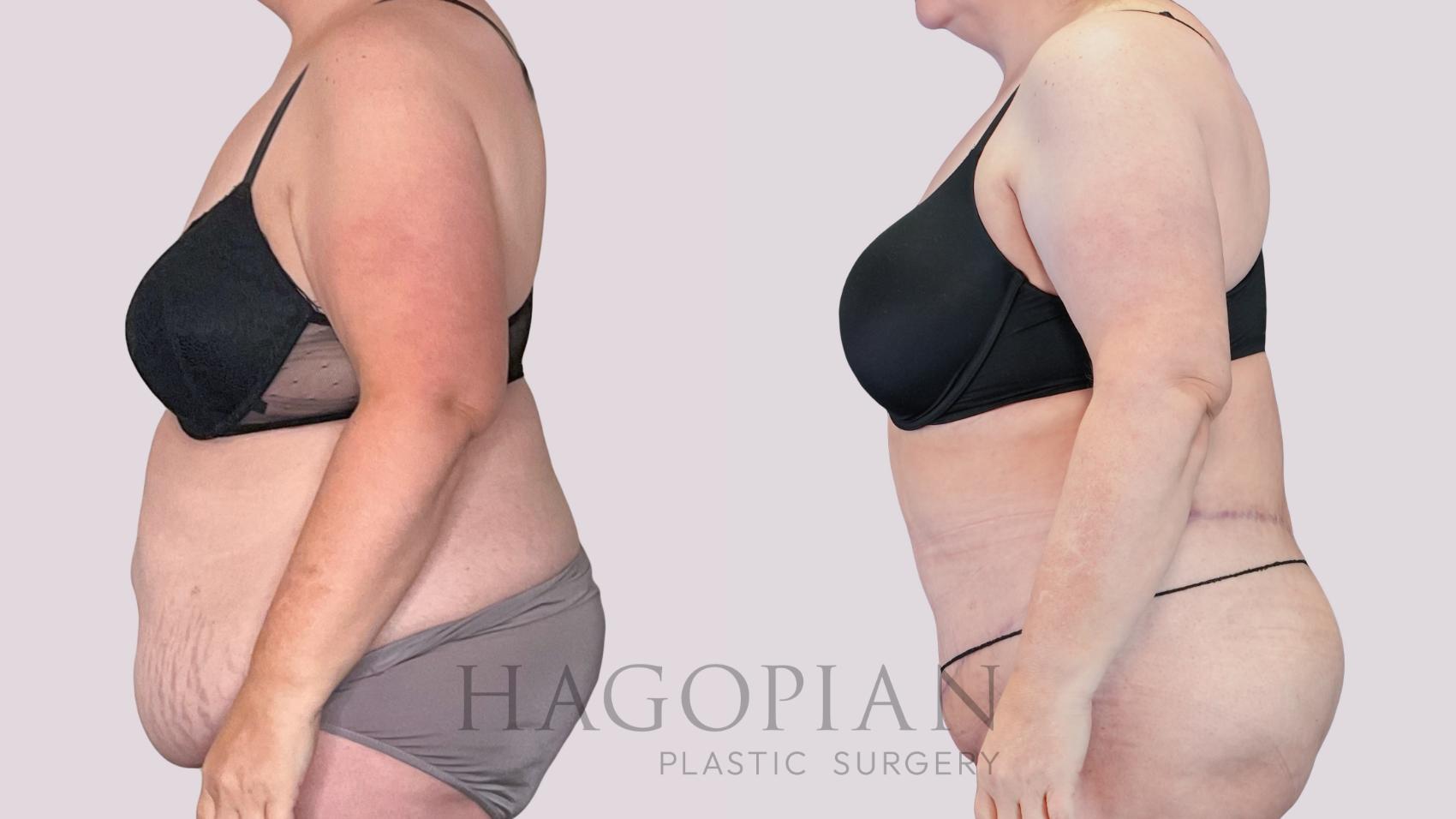 Before & After Drainless Tummy Tuck Case 271 Left Side View in Atlanta, GA