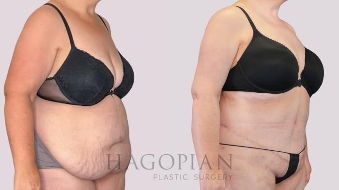 Before & After Drainless Tummy Tuck Case 271 Right Oblique View in Atlanta, GA