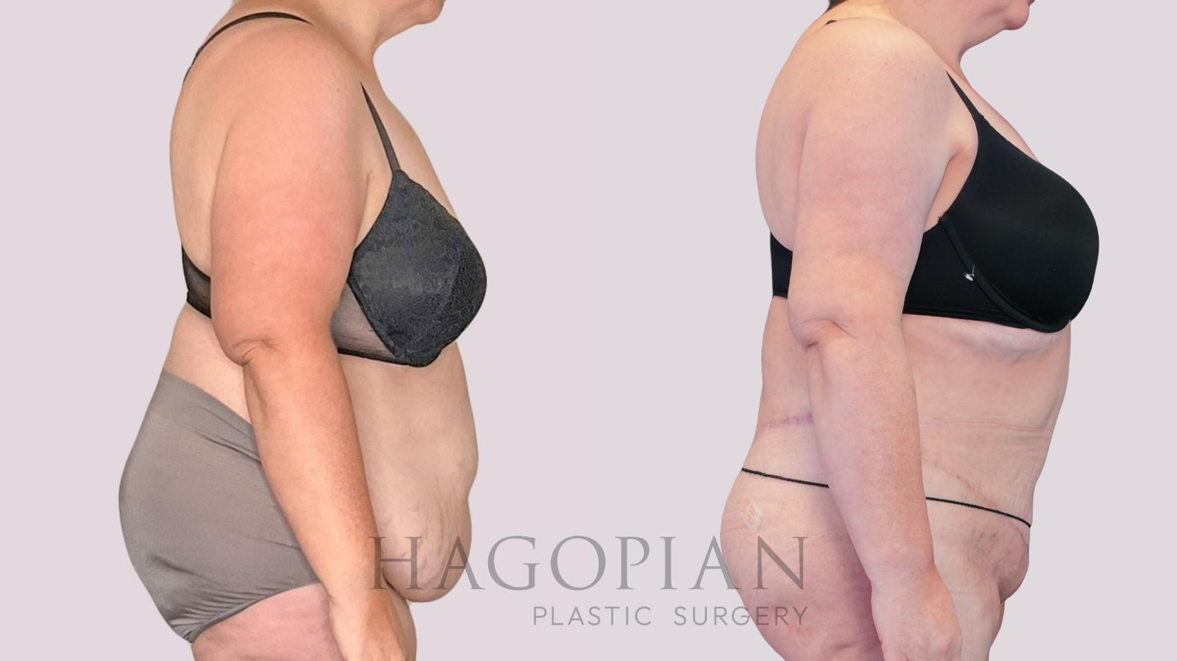 Before & After Drainless Tummy Tuck Case 271 Right Side View in Atlanta, GA