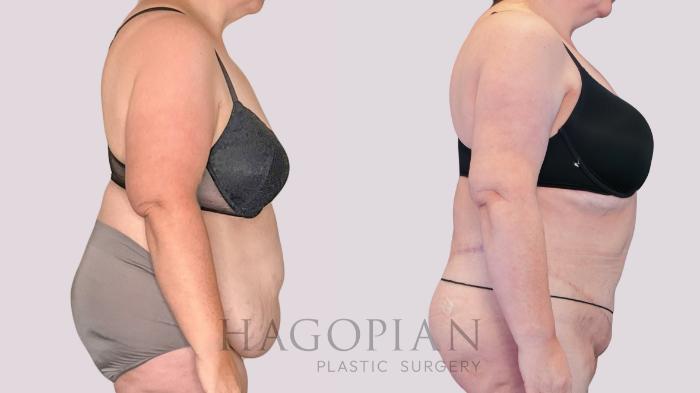 Before & After Drainless Tummy Tuck Case 271 Right Side View in Atlanta, GA