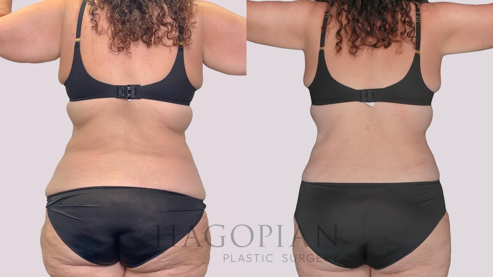 Before & After Drainless Tummy Tuck Case 279 Back View in Atlanta, GA
