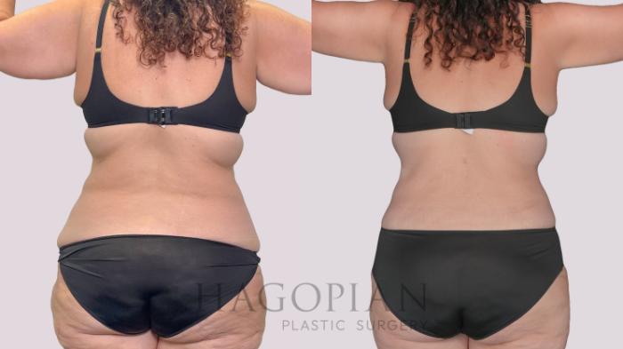 Before & After Drainless Tummy Tuck Case 279 Back View in Atlanta, GA