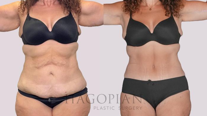 Before & After Drainless Tummy Tuck Case 279 Front View in Atlanta, GA